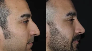 Nose Job in Dubai